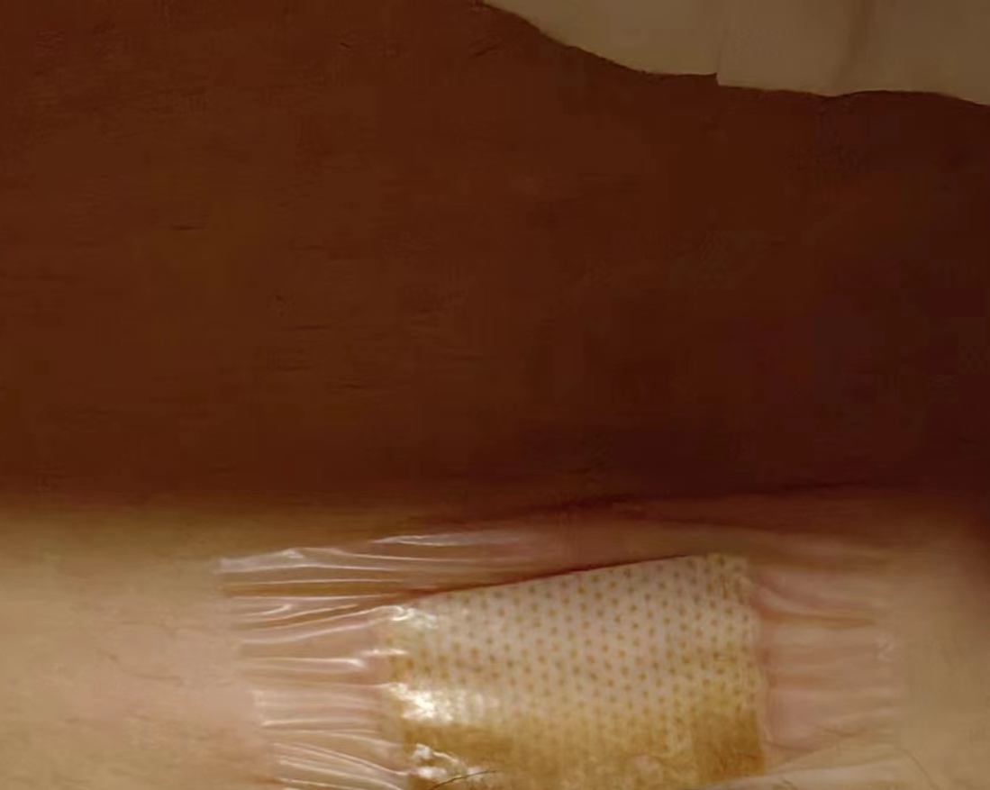 都是暖宝宝惹的祸